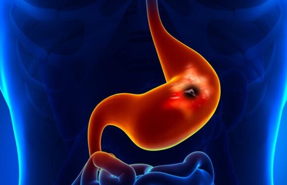 What are the complications of peptic ulcers? And how to diagnose it?