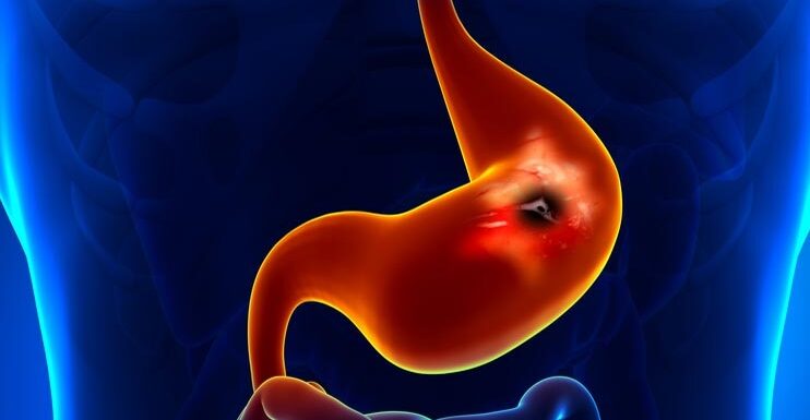 What are the complications of peptic ulcers? And how to diagnose it?