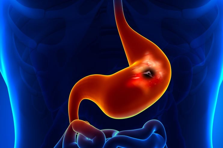 What are the complications of peptic ulcers? And how to diagnose it?